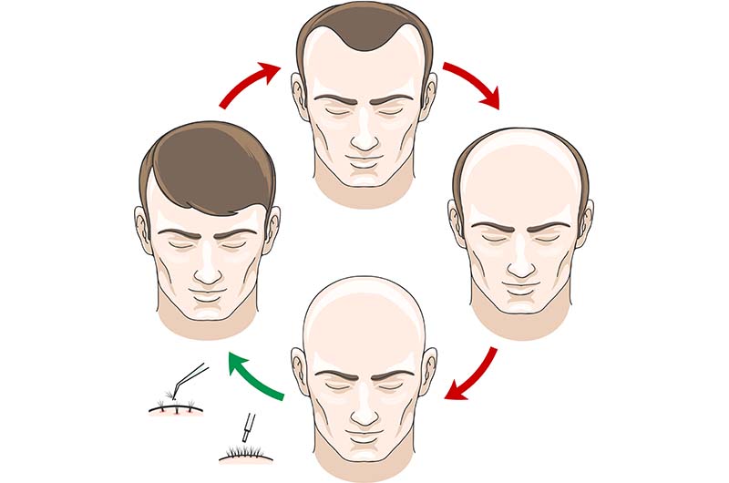 Hijama Treatment for Hair Growth in Pune